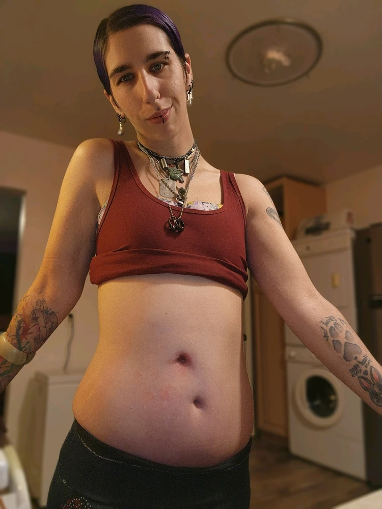 Feeding tube removed yesterday on 7/7/23!