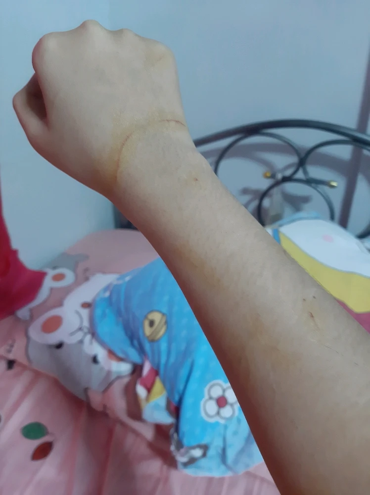 โดนกัดตอนพยายามเช็ดขี้ตาน้องด้วยผ้าชุบน้ำหมาดๆค่ะ น้อยใจ😔